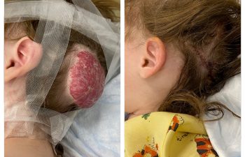 This lovely 2yo celebrated her birthday this week by getting her hemangioma removed! After being told that it would go away (and after the oral propranolol didn't stop it from growing bigger), she bravely went through her surgery yesterday. This was a challenging case to not only remove the entire hemangioma but to simultaneously reconstruct the scalp and bring hair-bearing skin together- and we got it just right! Now she can concentrate on more important things- like the color of her nail polish (nice touch Mom!) and no more comb-overs :)