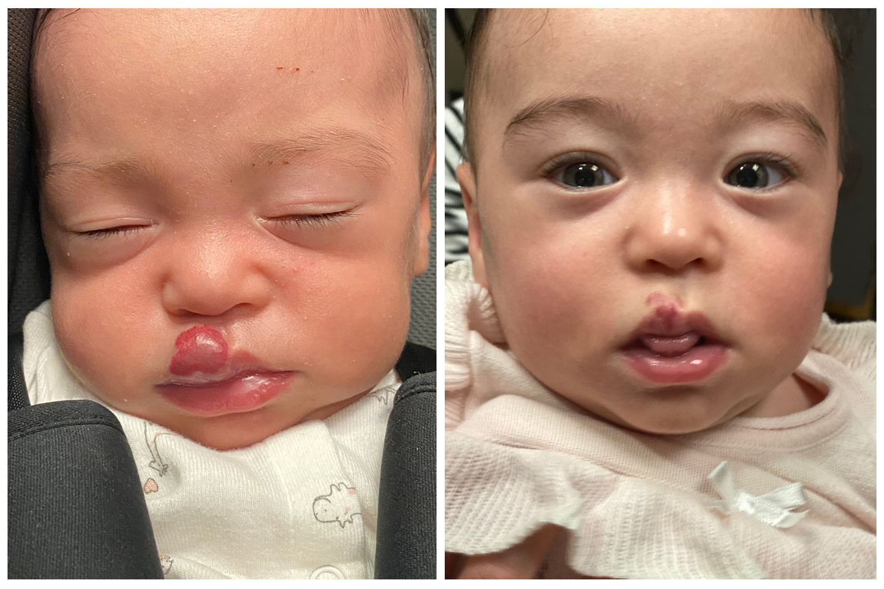 🥇 New York Hemangiomas Before and After Photos