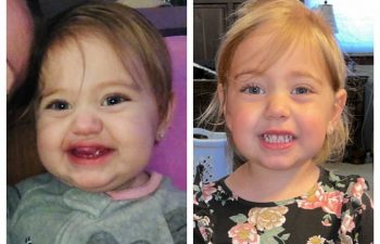 Here is a great example of how one surgery can make all the difference! This photo is just from a year later, and I had to go find the "before" photo to remind myself of just how big this lip hemangioma was! Keep smiling :)