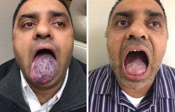 A: Venous malformation of the tongue. B: Postop result after one surgery and 3 YAG laser treatments. This hard working family man never took the time to get his birthmark looked at until his wife finally told him that his snoring was out of control. It turns out the venous malformation of his tongue was swelling up during sleep and causing him to have obstructive sleep apnea. When we met, I was able to first perform an office endoscopy to confirm his venous malformation was limited to just the tongue, and then we planned a treatment with laser therapy to be followed by a tongue debulking. Now he has a normal appearing tongue, can eat, swallow and talk normally; and more importantly, has no more sleep apnea, only mild snoring, and his wife can finally sleep through the night. #venousmalformationtongue #tonguebirthmark #happywifehappylife