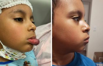 I am delighted to share these photos of a brave young boy who recently underwent an excision of a venous malformation. This was a challenging case due to the extensive hypertrophy of the lower lip over the years, as he was originally diagnosed as a "hemangioima" that never went away. Even though these photos are just 5 days after surgery, you can already see we achieved the proper shape and length of the lower lip in just one surgery. He is super-excited to have surgery behind him, and looking forward to showing his friends his "new" lip when he starts school in another week. #DrLevitinSurgery #OneandDone #Notahemangioma #venousmalformation #birthmarkremoval #SummerSurgery #VBCNewYork