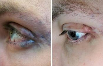 This patient still had residual venous malformation around the eyelids and orbit for several years after a debulking suegery. So we re-started YAG laser treatments (after a Covid-pause) and now he is seeing the results he had always hoped for! Stay strong, stay positive!