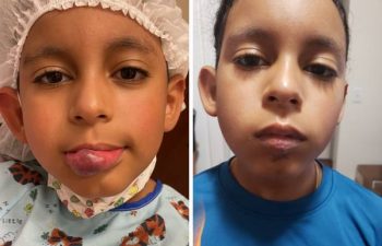 I am delighted to share these photos of a brave young boy who recently underwent an excision of a venous malformation. This was a challenging case due to the extensive hypertrophy of the lower lip over the years, as he was originally diagnosed as a "hemangioima" that never went away. Even though these photos are just 5 days after surgery, you can already see we achieved the proper shape and length of the lower lip in just one surgery. He is super-excited to have surgery behind him, and looking forward to showing his friends his "new" lip when he starts school in another week. #DrLevitinSurgery #OneandDone #Notahemangioma #venousmalformation #birthmarkremoval #SummerSurgery #VBCNewYork