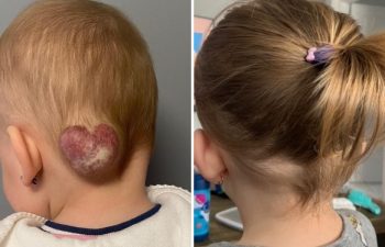 One year later. I am thrilled during vascular birthmark awareness month to share the one year result of this little girl who had a heart shaped hemangioma. Now that the hemangioma is gone, she can rock the ponytail without a problem!