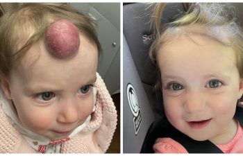 So excited to share another update on this adorable little girl who had her hemangioma excised earlier this year. Here is is now, ready for summer: ponytails, summing pools, and vacation!