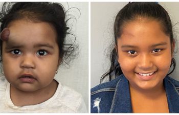 a girl before and after hemangioma removal