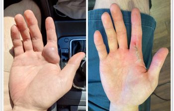 I am excited to share this 2 week follow result for a young man with a recurrent venous malformation of his right hand. As one can only imagine, this greatly affected his daily quality of life, daily activities, and caused severe pain any time he tried to grasp even a steering wheel or coffee mild. Despite having had a previous surgery, it recurred within a few months and left him miserable. I am so pleased to show his immediate post op appearance after suture removal showing an essential normal result, and he is able to enjoy his morning coffee again- pain-free!