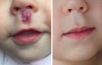 Laser makes the difference! So pleased to share this final result after pulse dye laser treatment for this hemangioma. Ivy starting treatment early we were able to stop and reverse all changes and achieve a normal appearance. Perfect!