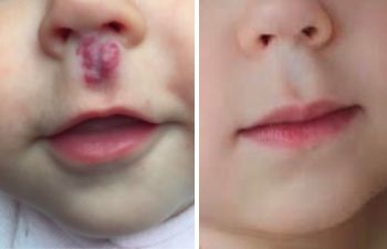 🥇 New York Hemangiomas Before and After Photos