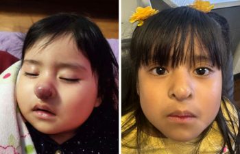 One year follow up for a nasal tip hemangioma: This adorable 3yo came in a year after her surgical removal and reconstruction of a nasal hemangioma. She had been treated on oral propranolol initially which stopped the growth, but it never returned back to normal (as is often the case for hemangiomas of the nose, lips and ears). Now one year later, the nose has its normal shape, symmetry, and while slightly larger for age, this will naturally balance out as she progresses through adolescent growth. These are some of the most challenging cases we treat as specialists as the nose is such a delicate and complicated structure. I'm thrilled that mom has allowed me to share this result.