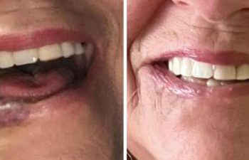 Sometimes just a little is enough, and in this case laser alone after three treatments, return this lovely ladies lip back to normal!