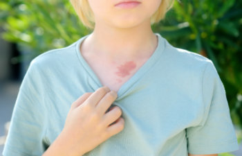 mark on the skin of chest of eight years old child, 
