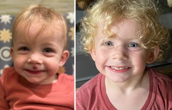 This adorable little girl surprised me this week with a follow up visit that made me do a double take! I had a hard time remembering where her hemangioma had been as her lips look perfect! We did one small surgery and a couple lasers after, and her smile tells the whole story! So happy for the entire family to have this behind them.