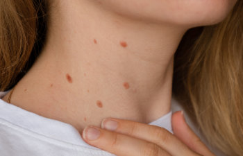 woman showing her birthmarks on neck skin, 