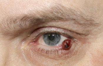 hemolymphangioma on the inferior eyelid of a man, 