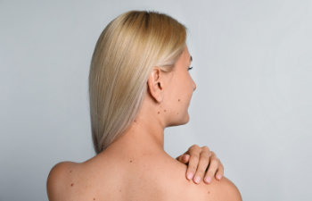 young woman with birthmarks on light grey background, 