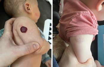 Caught just in time! This child had an early ulcerating hemangioma that was not going to go away on its own. So we started laser therapy and medical therapy together, and after several months we cleared nearly 95% of the hemangioma! And just in time for spring break :)