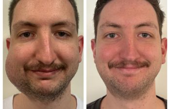 So happy to share a 6 week follow up on one of the nicest birthmark patients you will meet! After finally getting approval with his insurance, his venous malformation was treated with a single surgery, and his perfect smile shows how he feels about his new look! Congrats to our entire team in the office and OR for helping to make this a success!