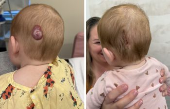 One and Done! Congrats to this little girl getting her hemangioma removed just in time for her first birthday!
