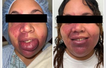 I am so excited to share the final result from a recent surgery for port wine stain hypertophy of the lower lip. For several years this young woman’s lip continues to grow and cause problems with eating and talking. Now she feels like her life is finally back to normal and feels the shape and function is perfect!