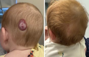 Excited to share a wonderful result at 2 month follow up after excision of a large scalp hemangioma. We can barely see the scar and her hair has grown normally; no need for a comb over!