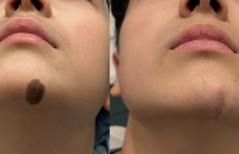 A two month postop result from an excision of a giant pigmented nevus of the chin. We did a 3 stage serial excision to avoid any skin grafts!